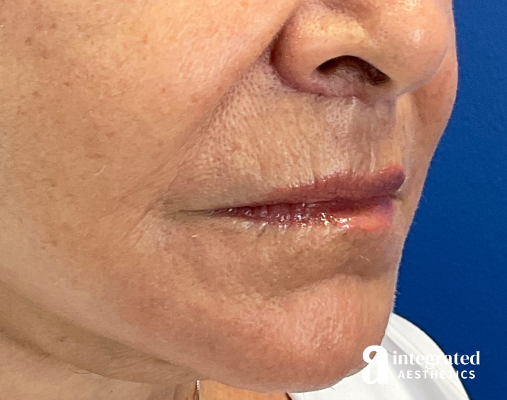 28764(Lip Lift)-13