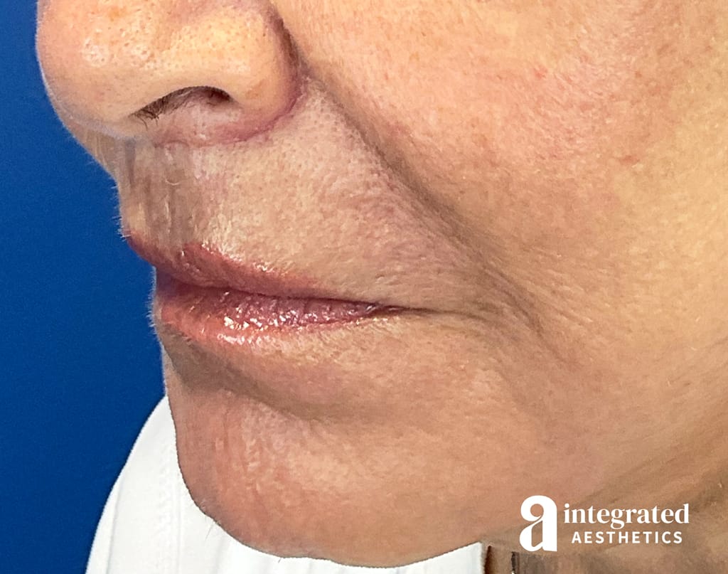 28764(Lip Lift)-15