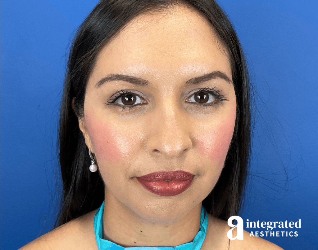 Dermal Fillers