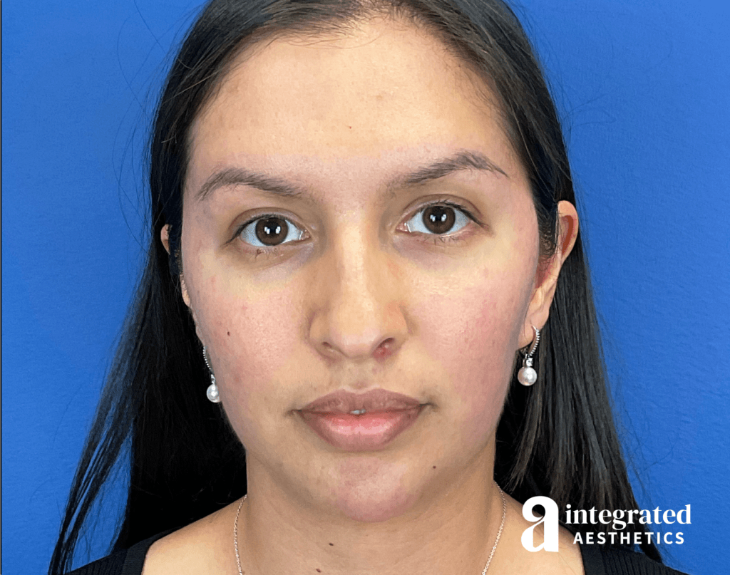 Dermal Fillers