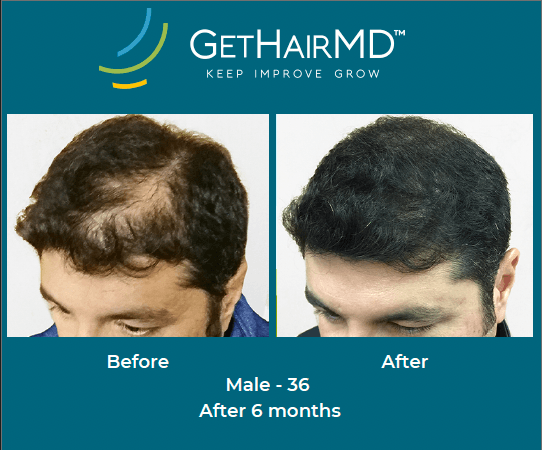 Before and after non-surgical hair restoration with GetHairMD