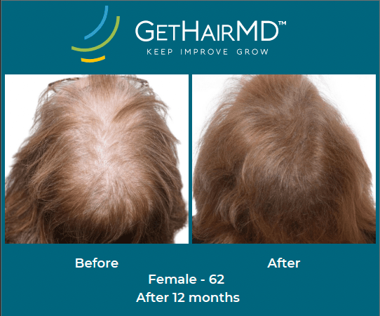 Before and after non-surgical hair restoration with GetHairMD