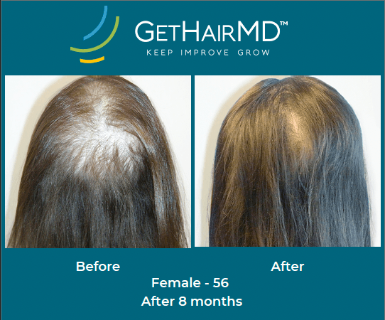 Before and after non-surgical hair restoration with GetHairMD