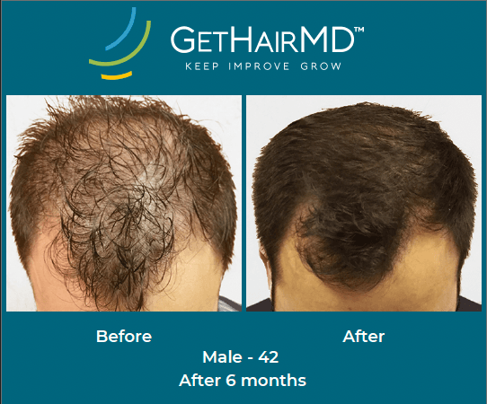 Before and after non-surgical hair restoration with GetHairMD