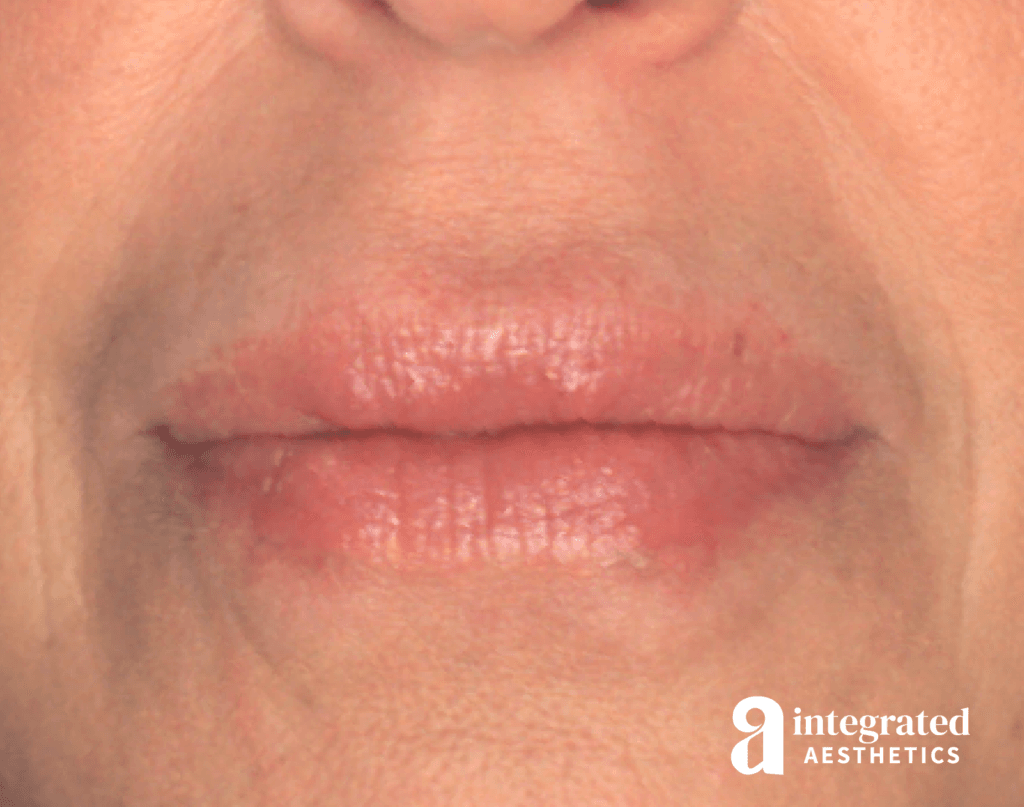 Resolved Aesthetic Complications