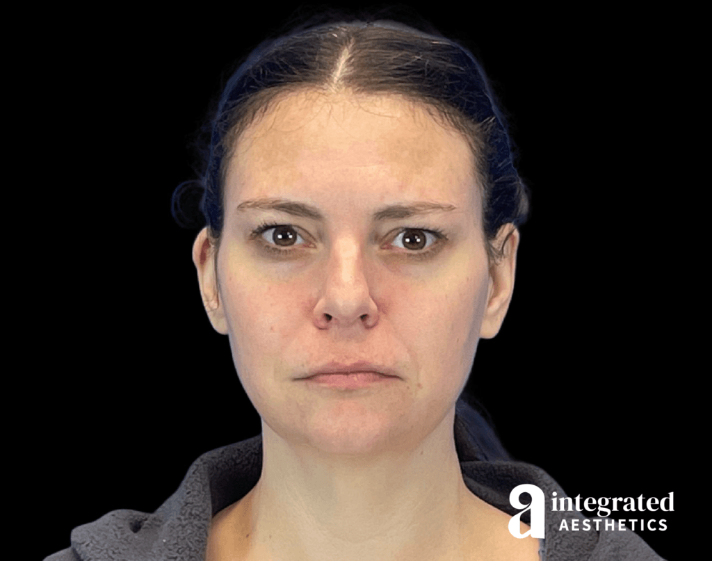 Wrinkle Relaxers