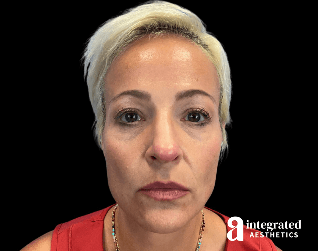 Dermal Fillers