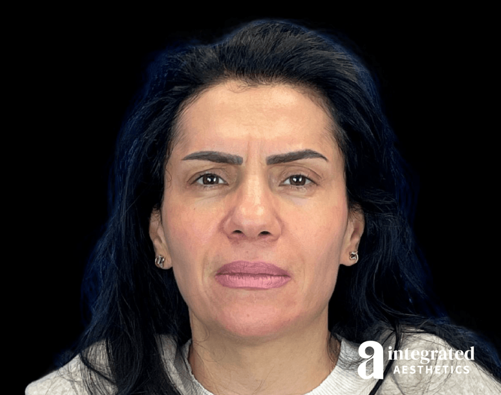 Wrinkle Relaxers