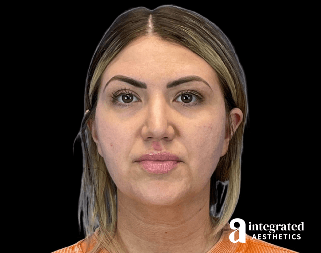Dermal Fillers