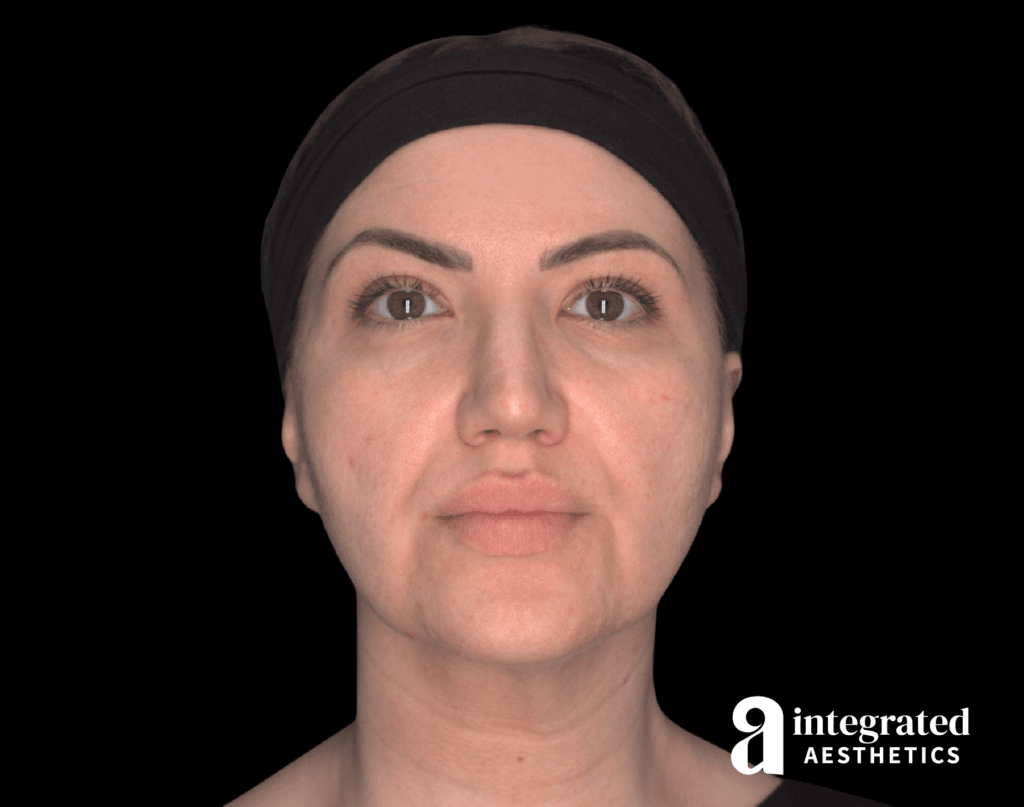Dermal Fillers