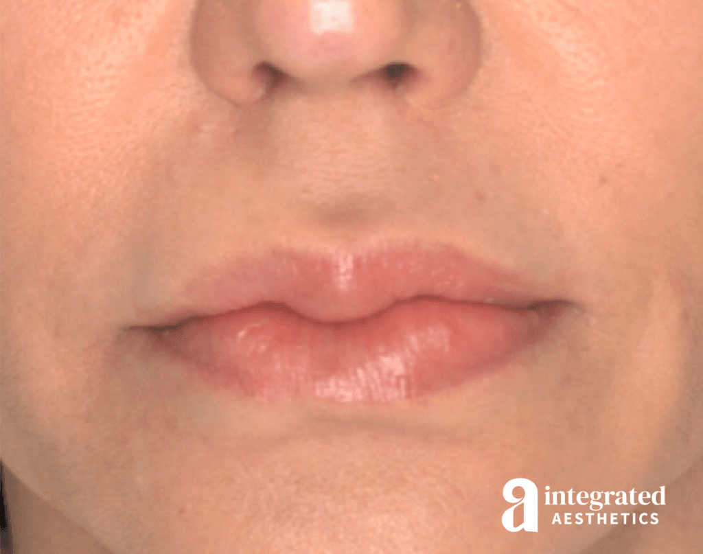Lip Lift