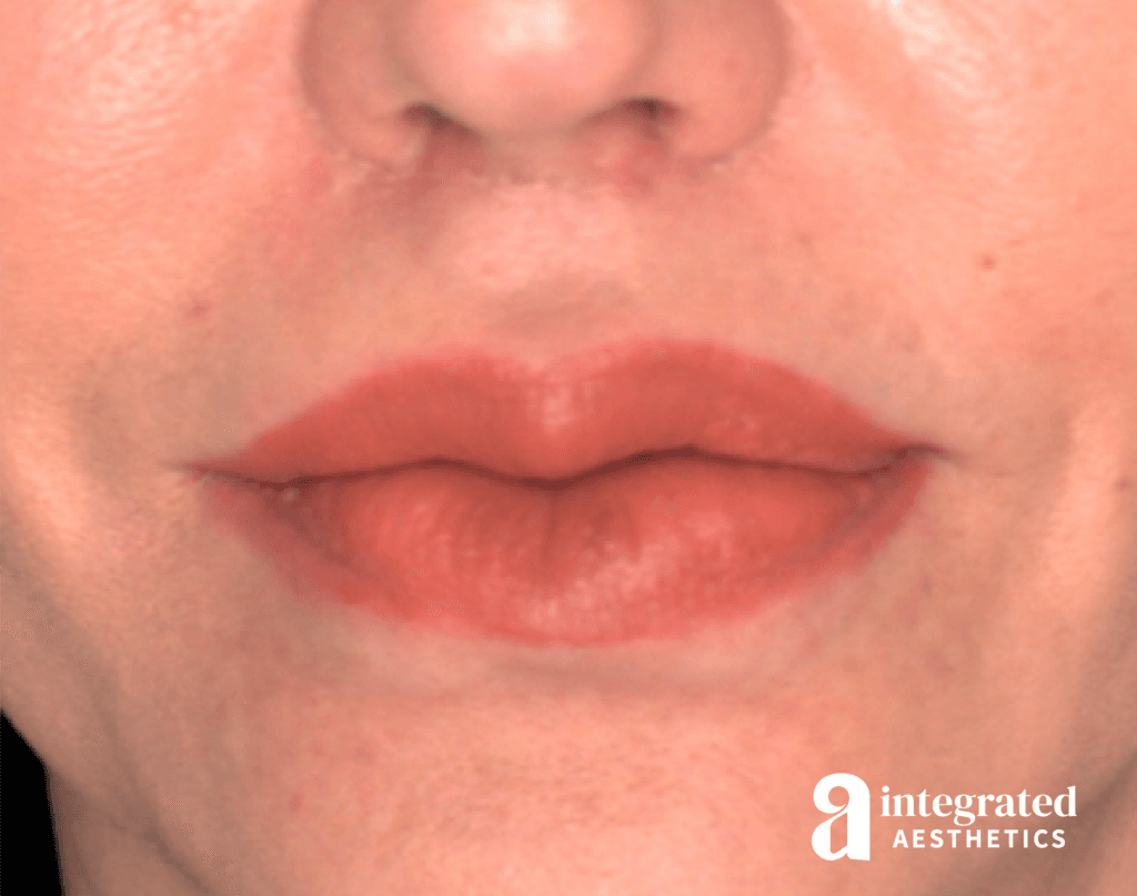 Lip Lift