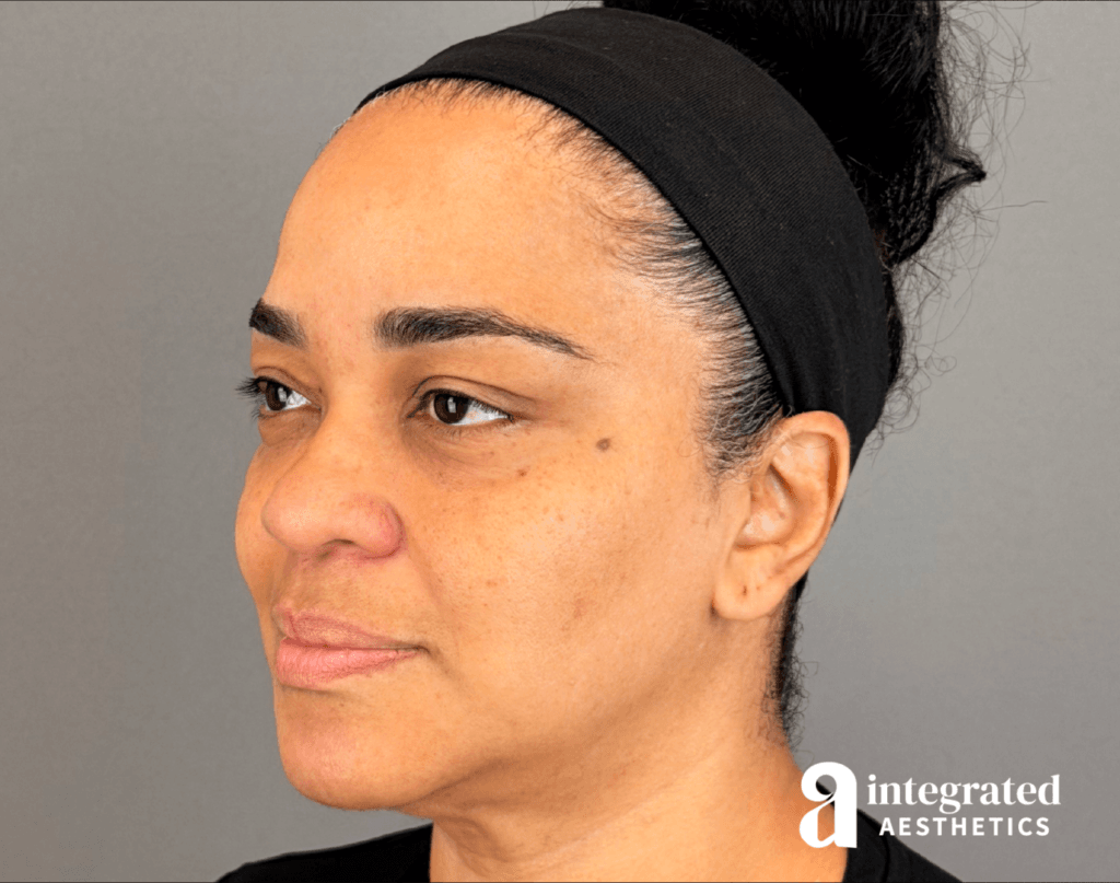 20547-md-codes-dermal-filler–12