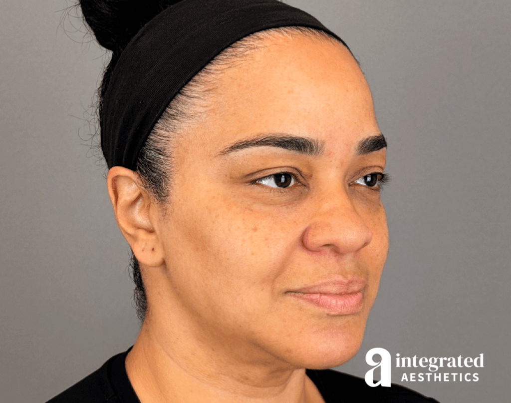 20547-md-codes-dermal-filler–14