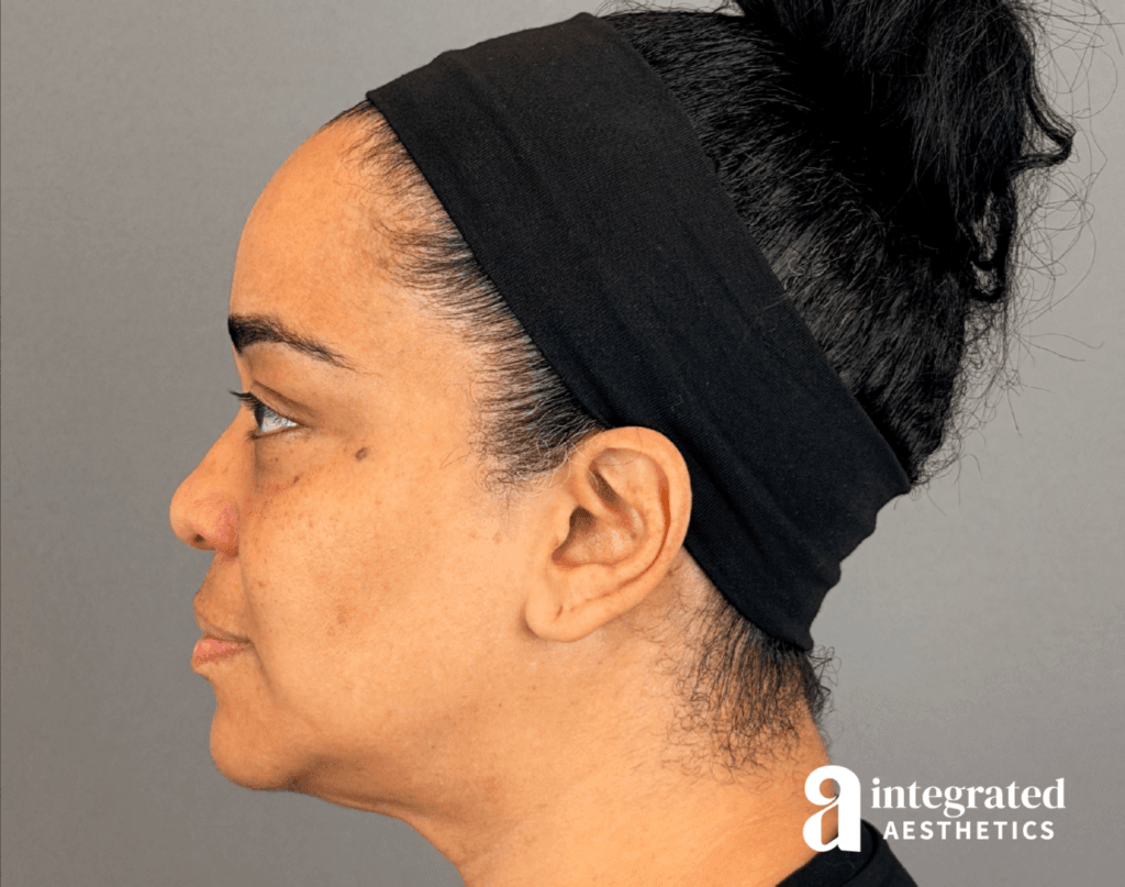 20547-md-codes-dermal-filler–16