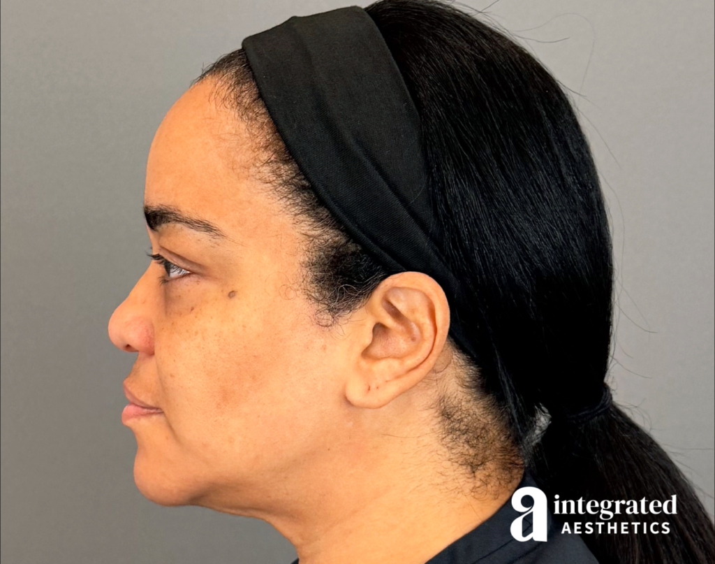 20547-md-codes-dermal-filler–17