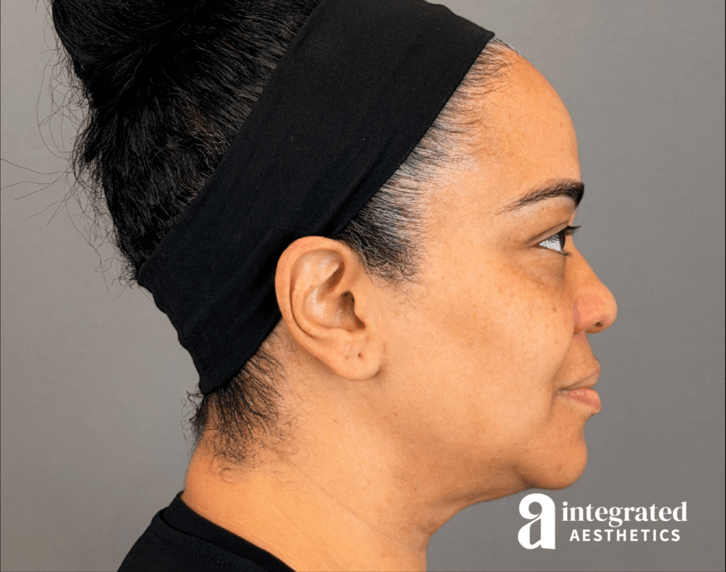 20547-md-codes-dermal-filler–18