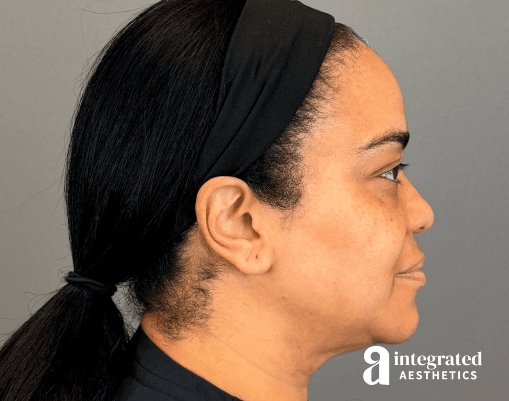 20547-md-codes-dermal-filler–19