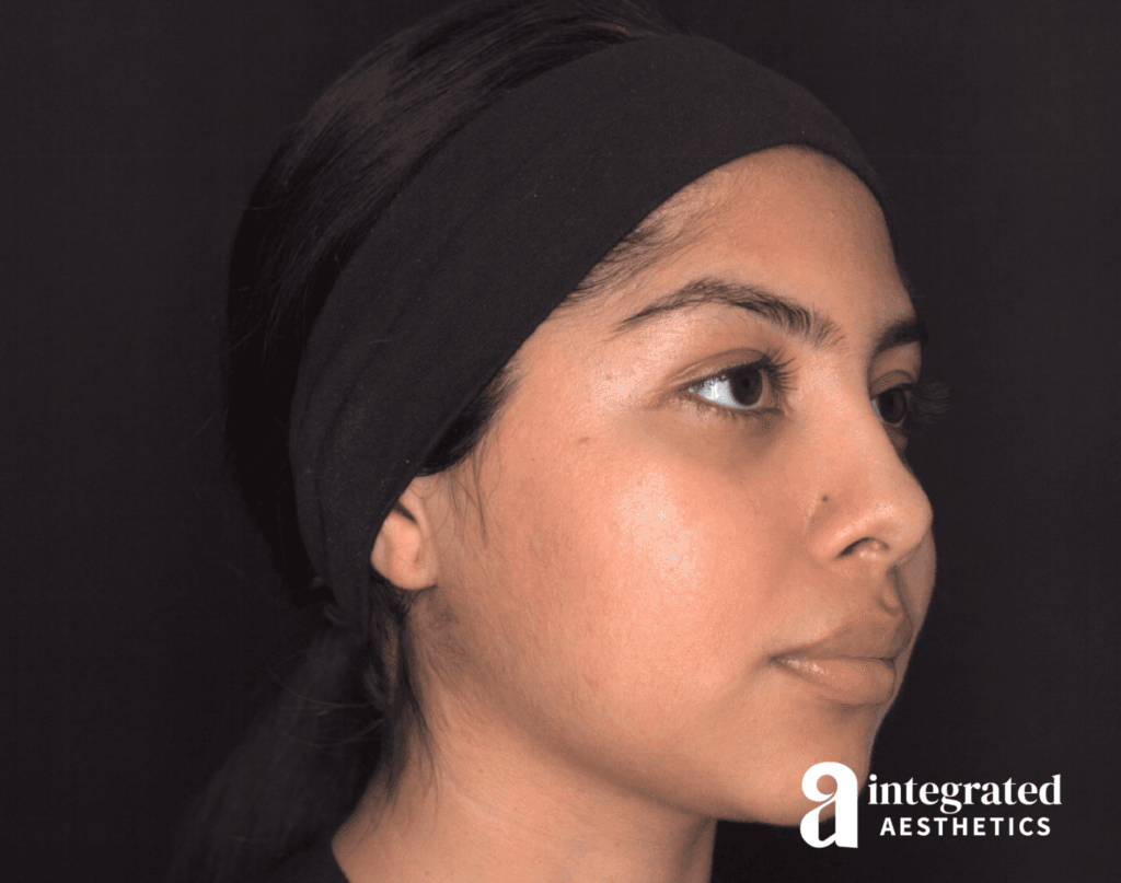 29041-Cheek-Dermal-Filler-MD-Codes-After-Angled-Left-15