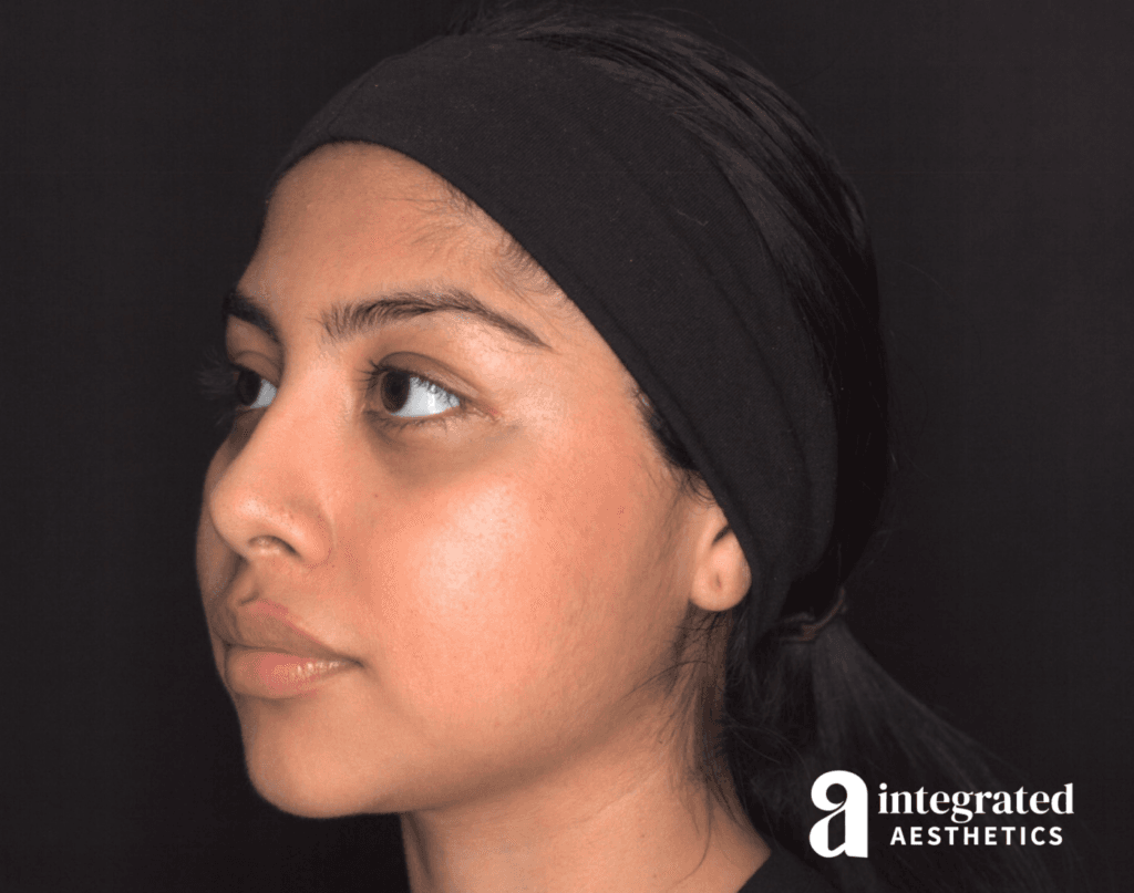 29041-Cheek-Dermal-Filler-MD-Codes-After-Angled-Right-13