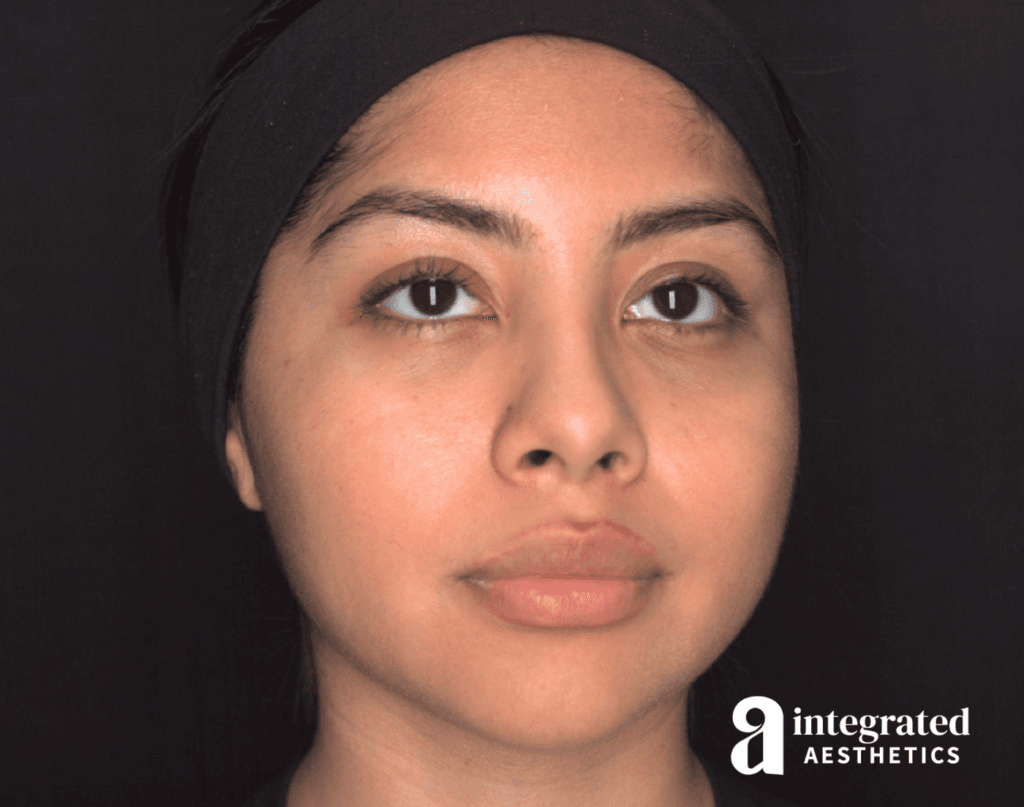 Dermal Fillers
