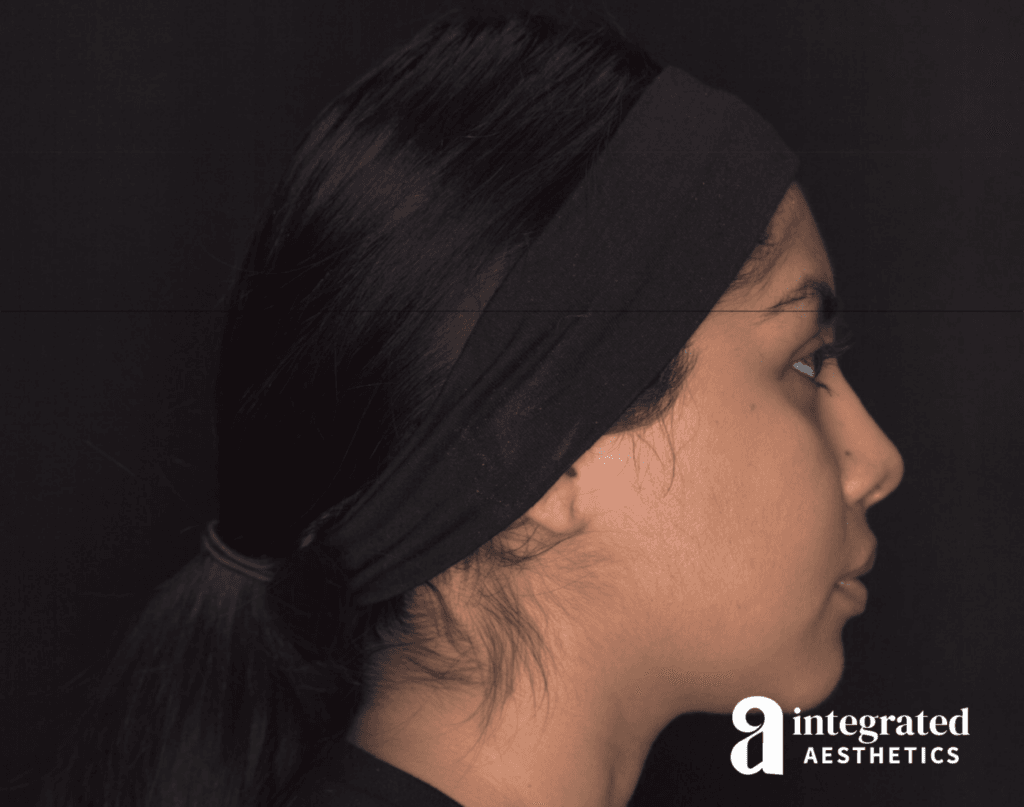 29041-Cheek-Dermal-Filler-MD-Codes-After-Left-19