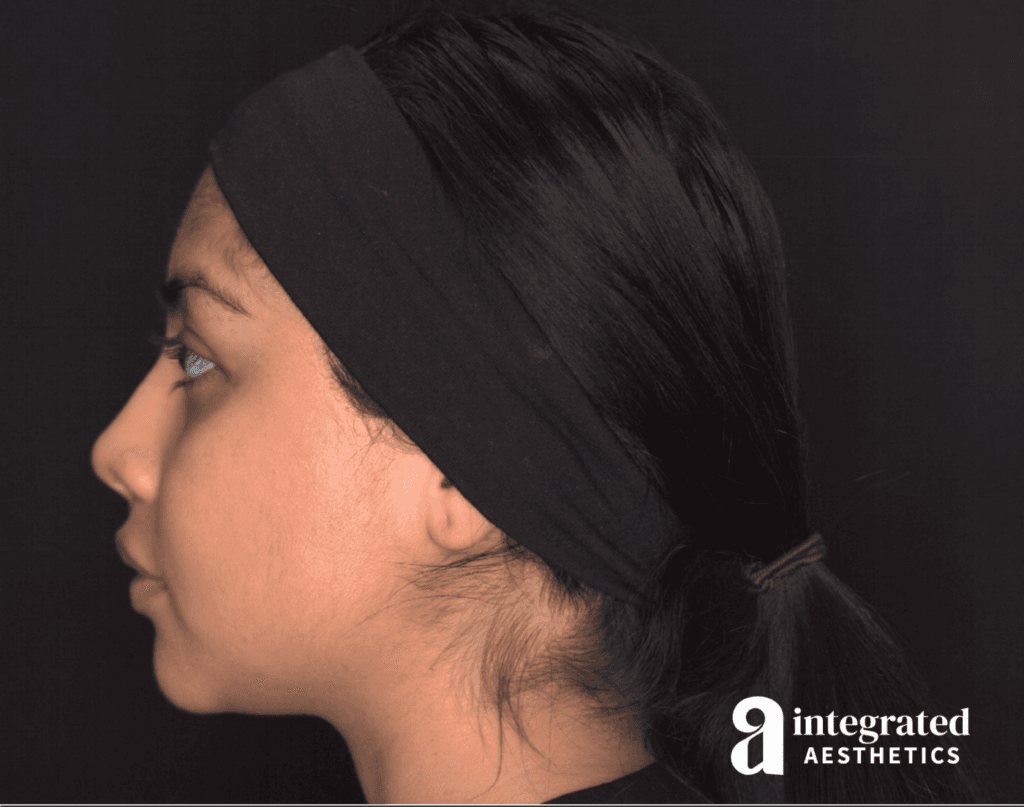 29041-Cheek-Dermal-Filler-MD-Codes-After-Right-17
