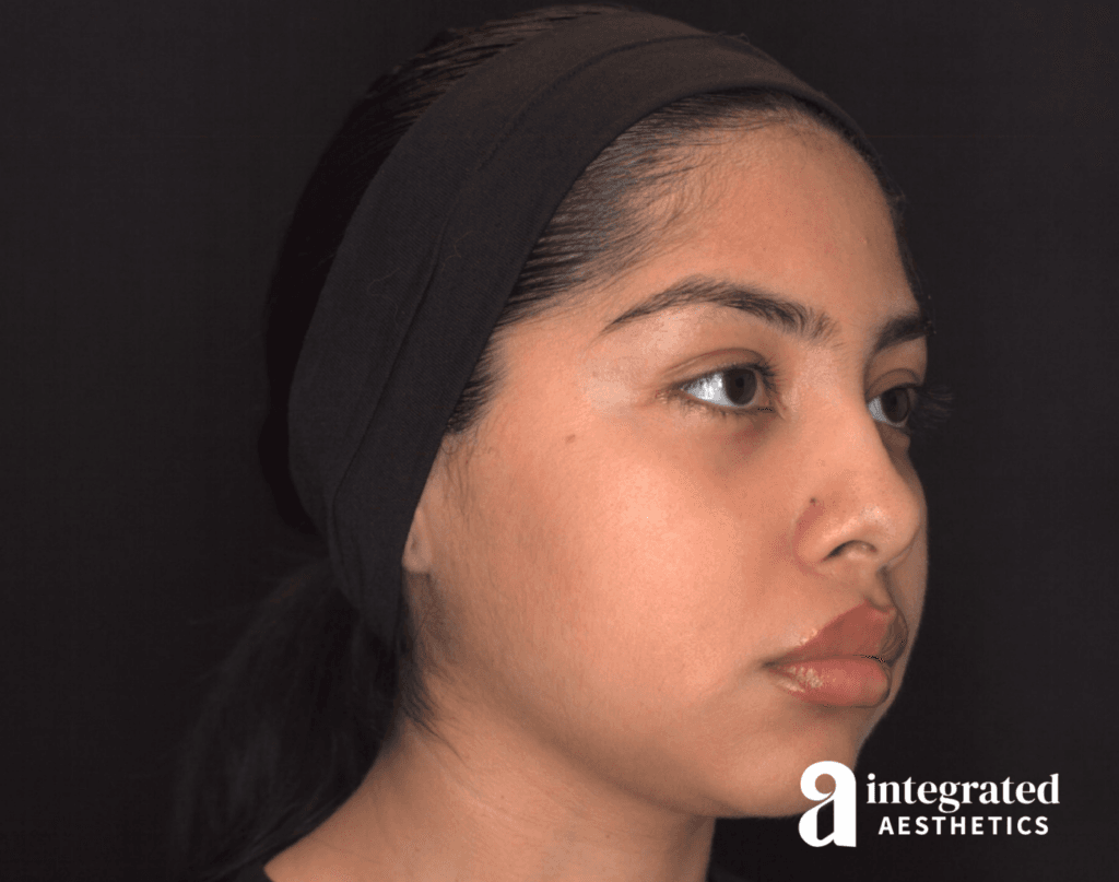 29041-Cheek-Dermal-Filler-MD-Codes-Before-Angled-Left14