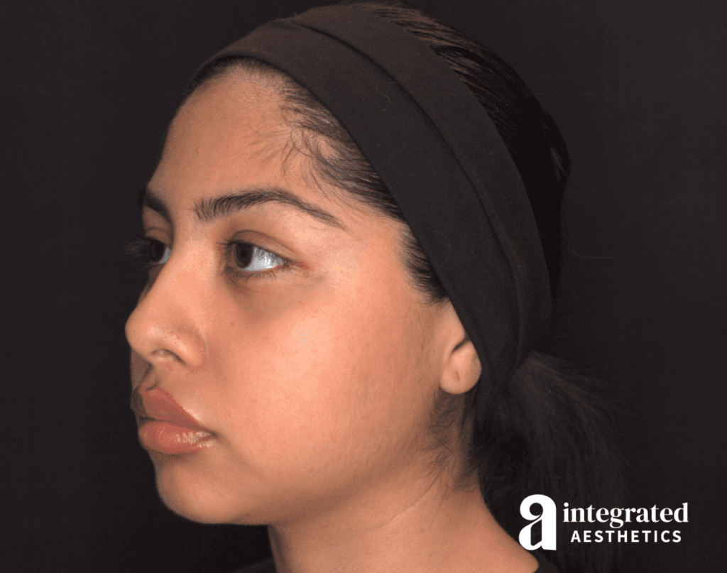 29041-Cheek-Dermal-Filler-MD-Codes-Before-Angled-Right-12