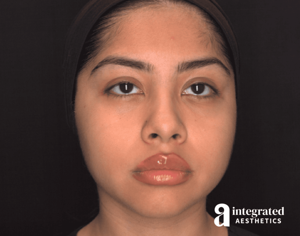 Dermal Fillers