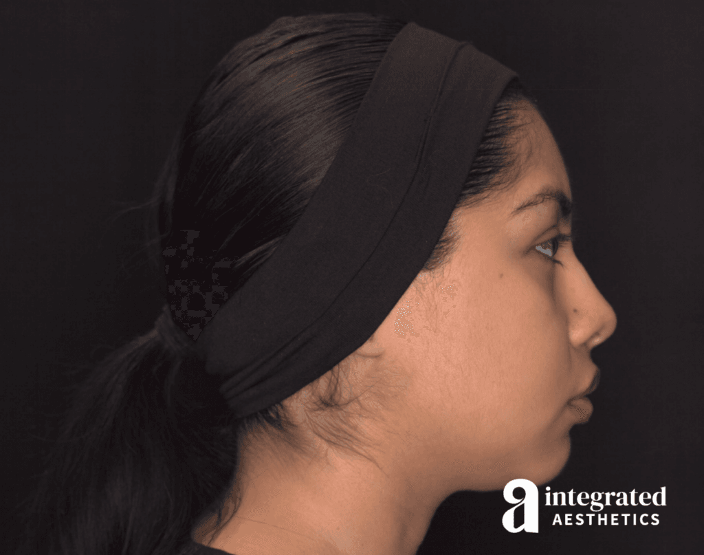 29041-Cheek-Dermal-Filler-MD-Codes-Before-Left-18