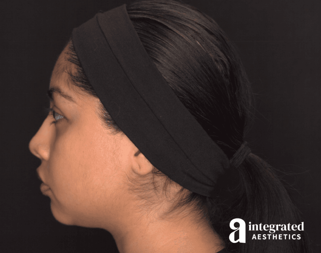29041-Cheek-Dermal-Filler-MD-Codes-Before-Right-16