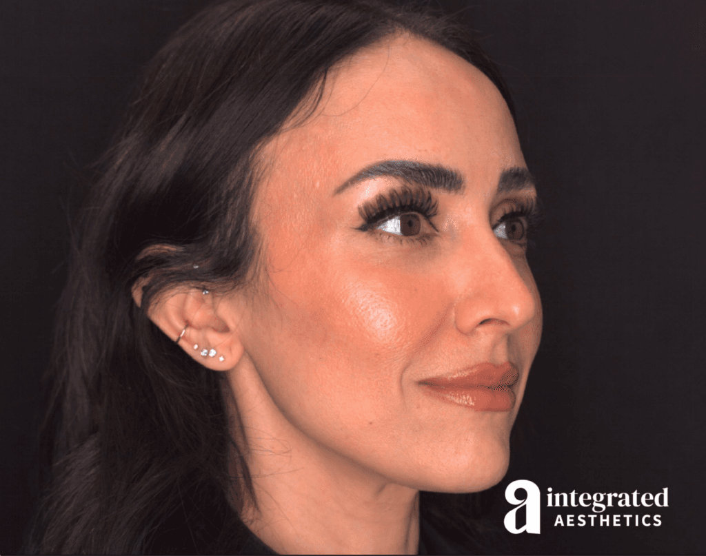 29088-Cheek-Dermal-Filler-MD-Codes-After-Angled-Left-15