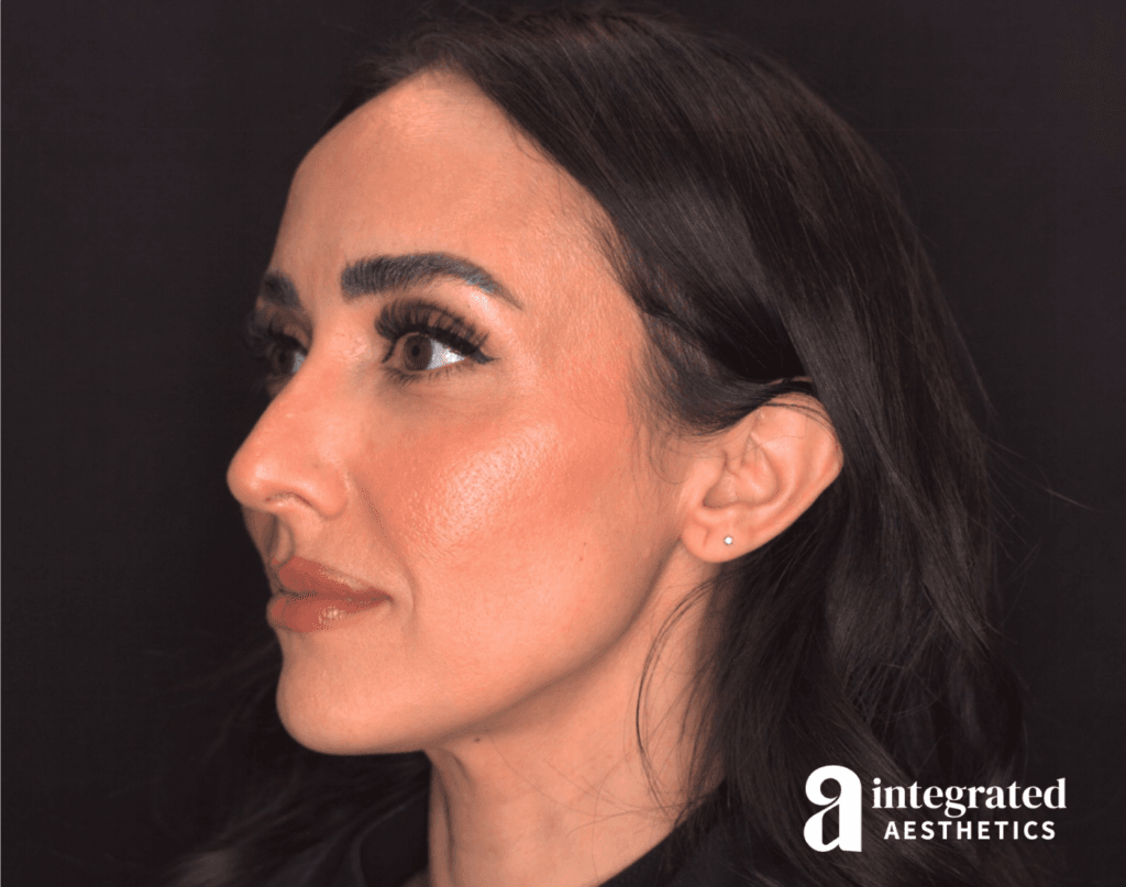 29088-Cheek-Dermal-Filler-MD-Codes-After-Angled-Right-13