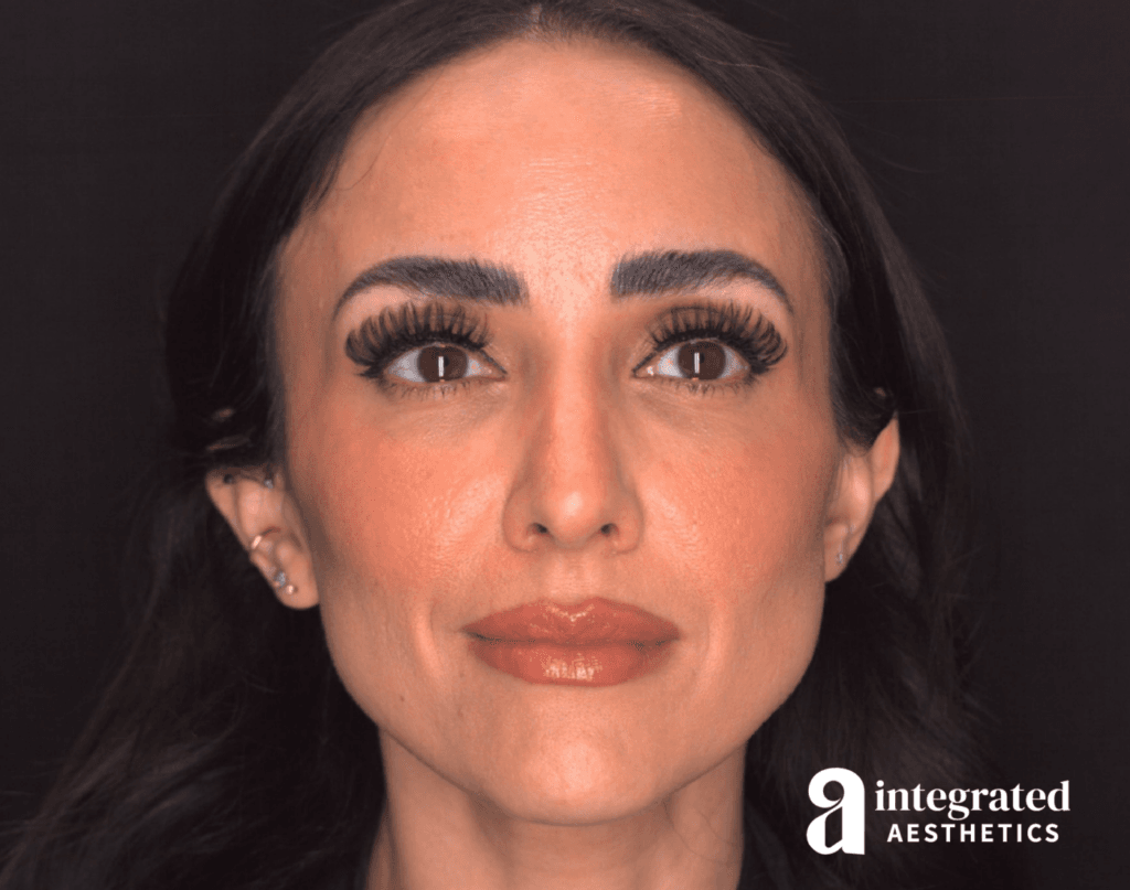 Dermal Fillers