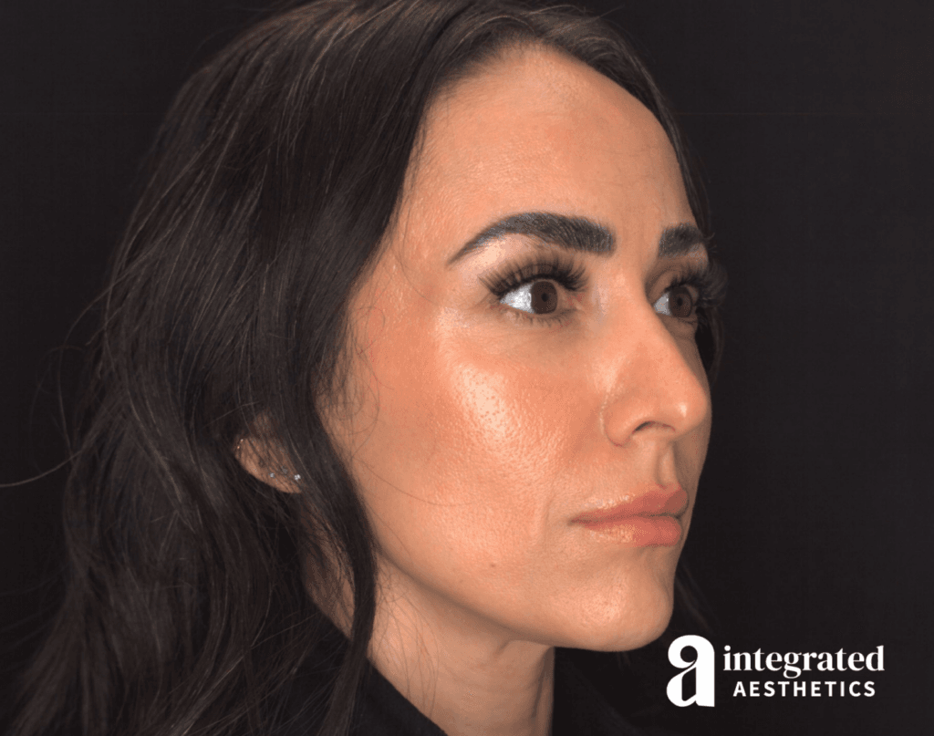 29088-Cheek-Dermal-Filler-MD-Codes-Before-Angled-Left-14