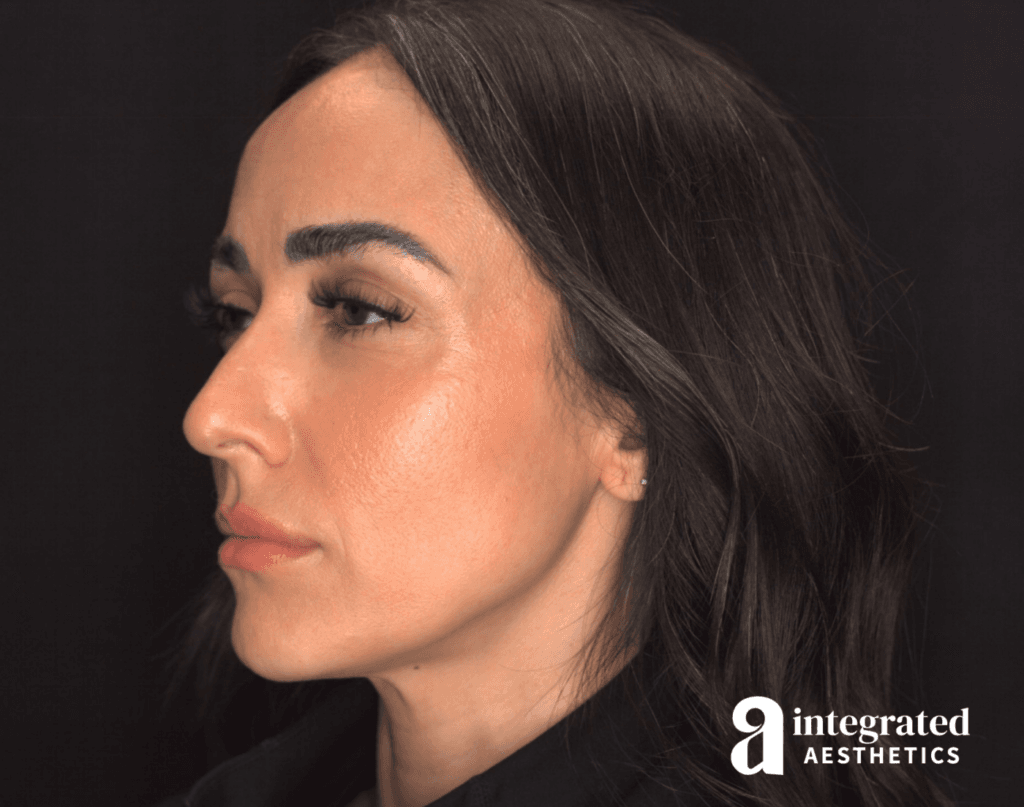 29088-Cheek-Dermal-Filler-MD-Codes-Before-Angled-Right-12