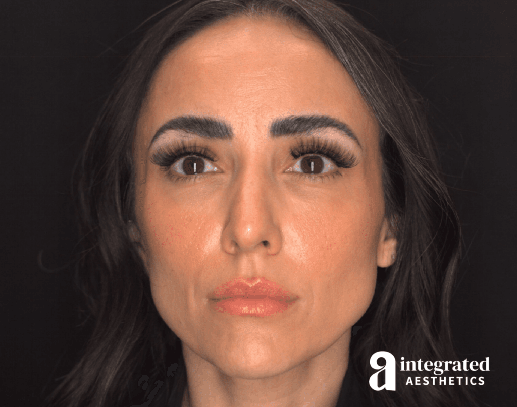 Dermal Fillers