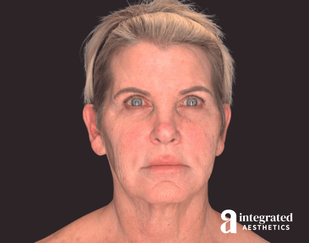 65-year-old female before deep plane facelift, neck lift, endoscopic brow lift, facial fat grafting, and CO2 laser resurfacing, front view.