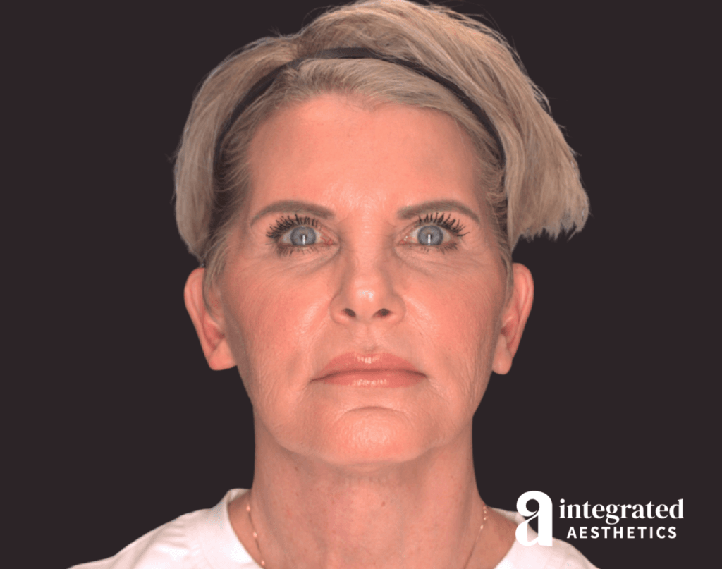65-year-old female 7 weeks after deep plane facelift, neck lift, endoscopic brow lift, facial fat grafting, and CO2 laser resurfacing, front view.