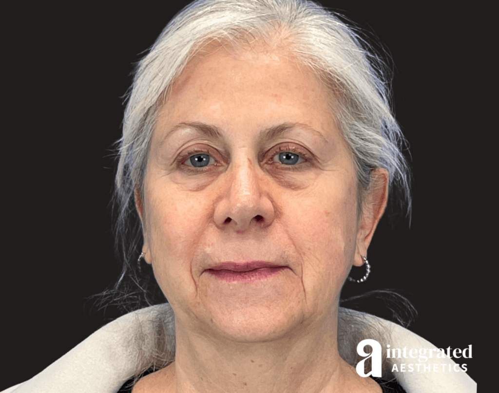 Dermal Fillers