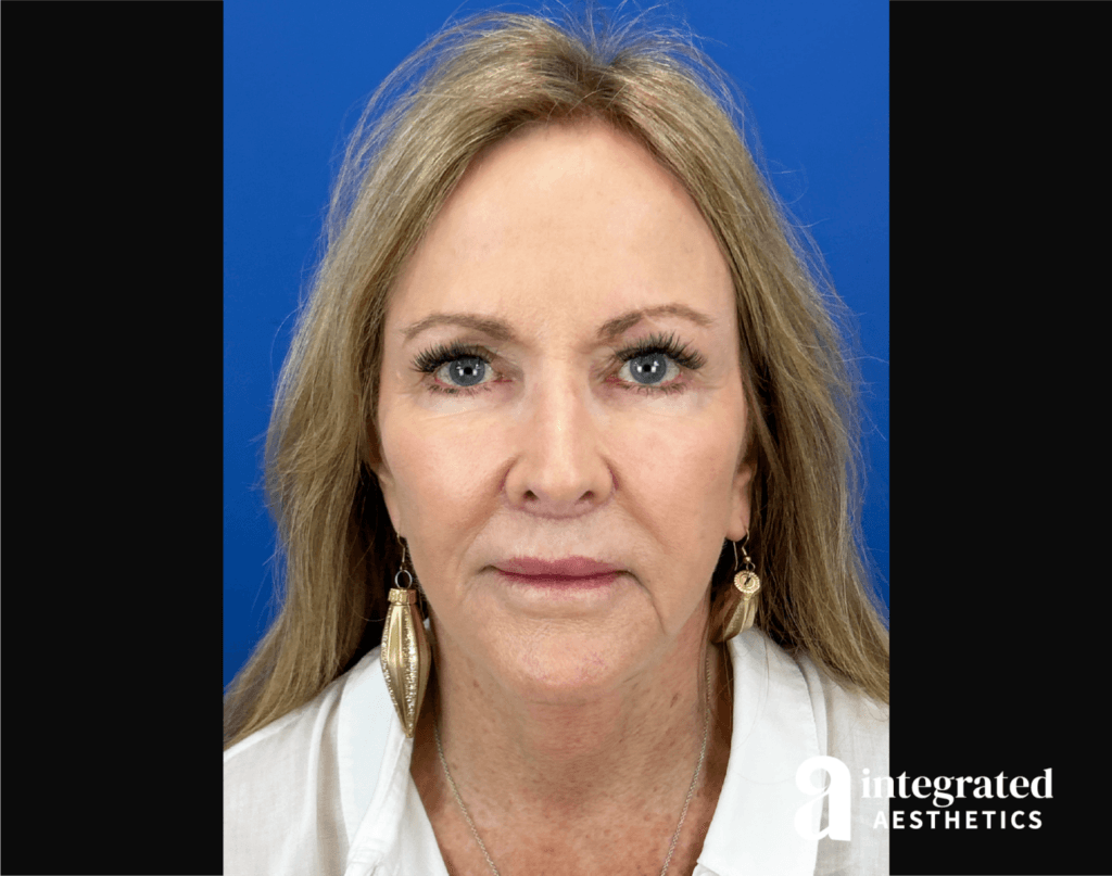 Natural 2-month post-op front view results after an extended deep plane face and neck lift, endoscopic brow lift, lip lift, and facial fat grafting by Dr. Young Cho.
