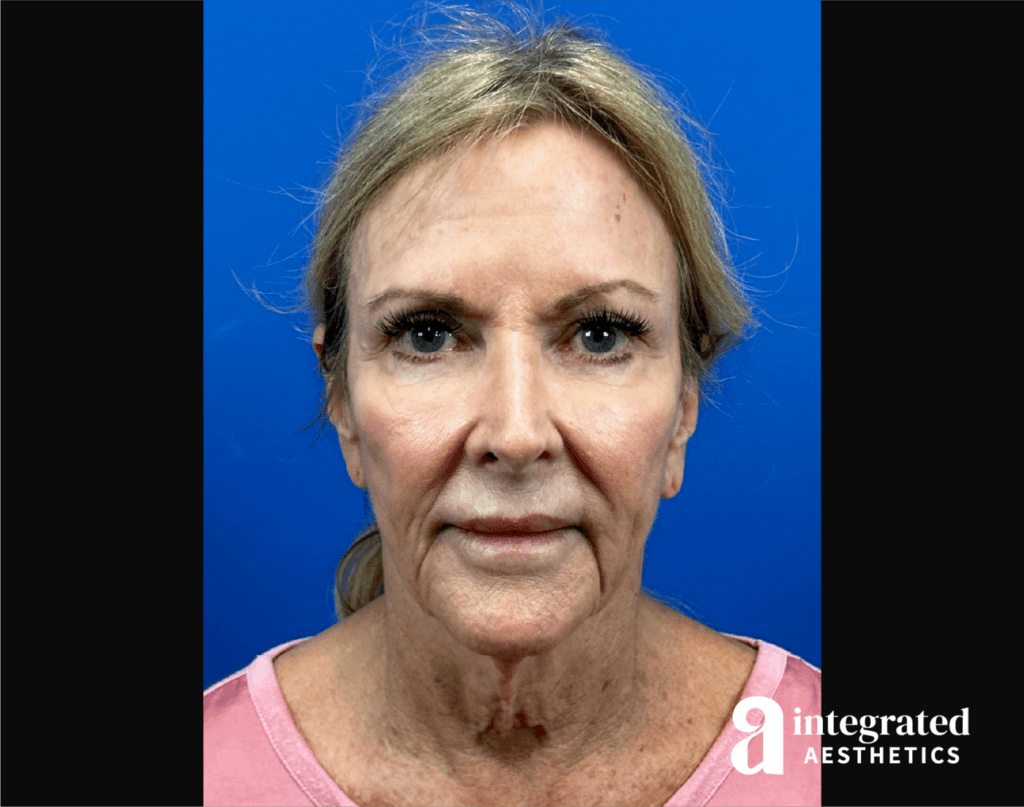 Before photo showing advanced facial laxity in the brows, mid-face, jawline, and neck of a 73-year-old female patient before structural rejuvenation.
