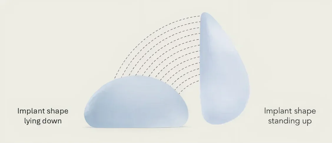 motiva breast implant example