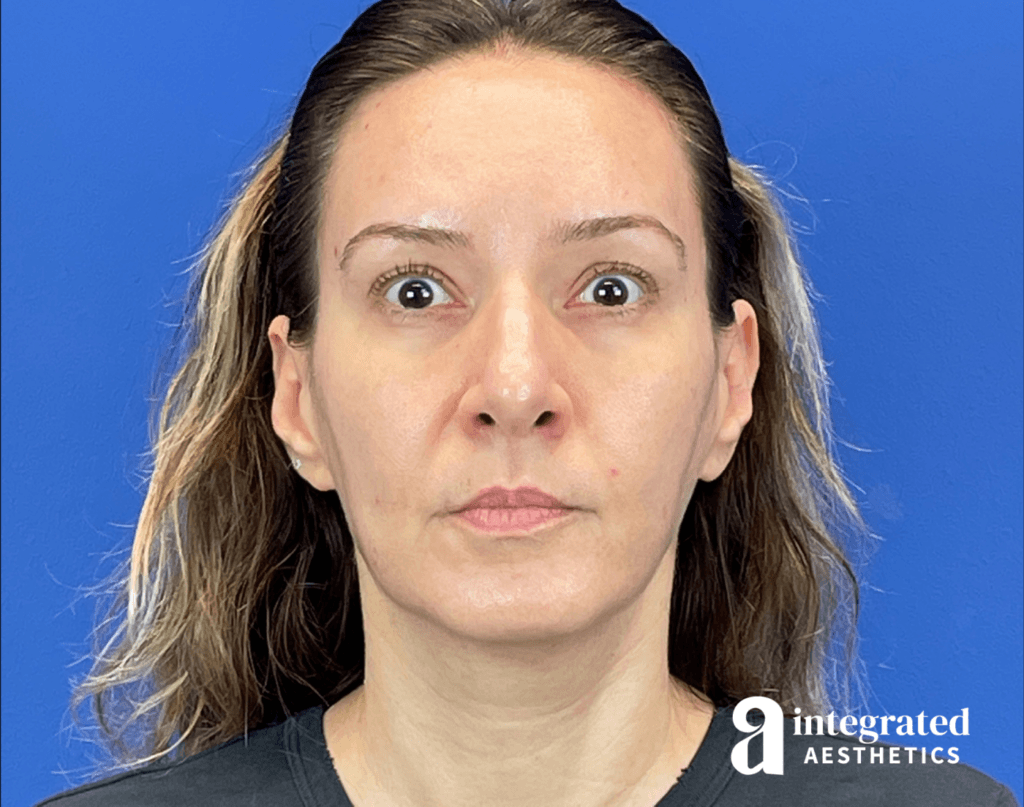 01070-Botox-after-brows-raised-15