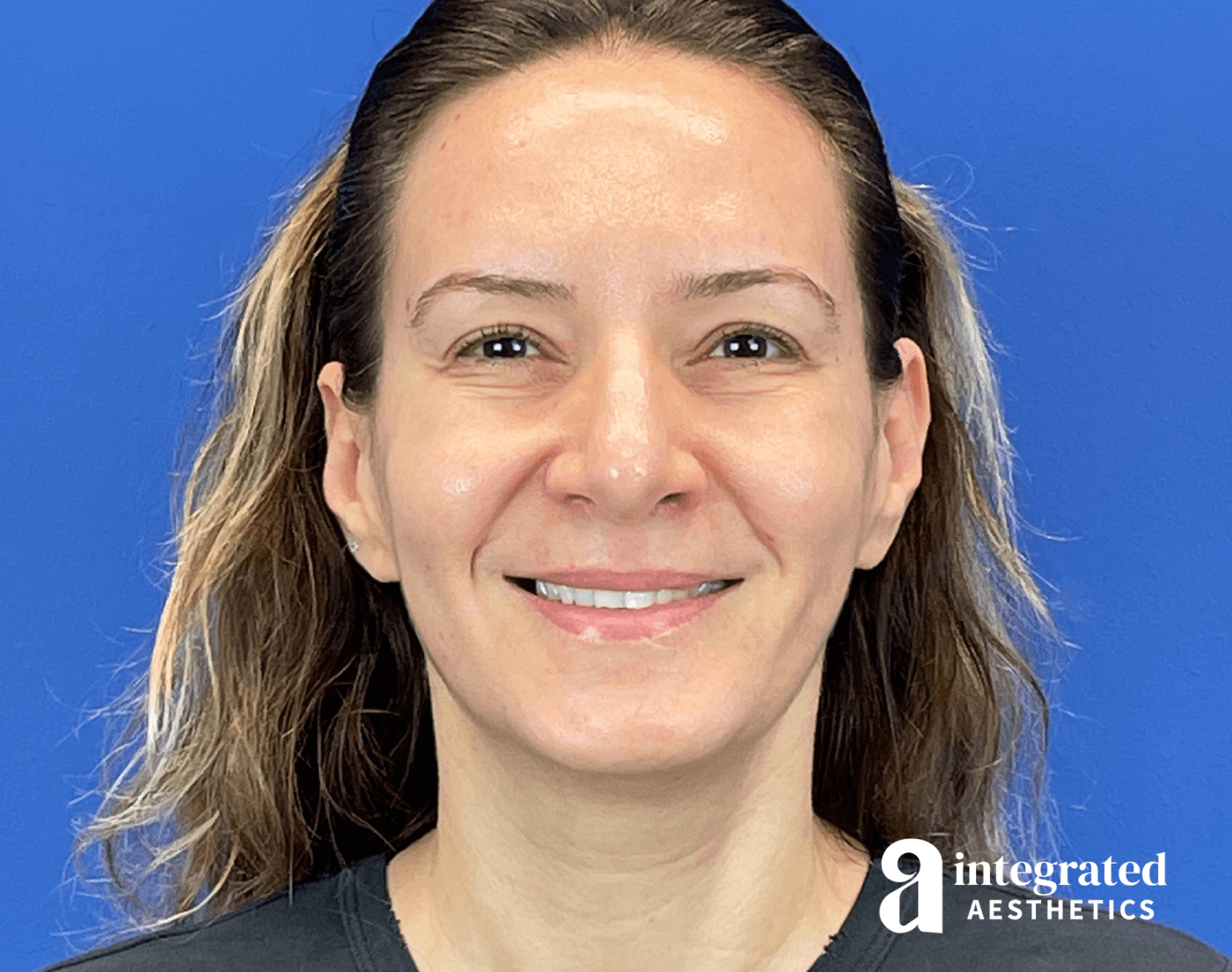 Full-Face Rejuvenation with Botox: A 49-Year-Old Patient Case Study in The Woodlands & Spring, TX