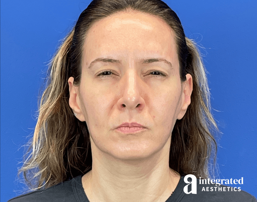 01070-Botox-after-frown-13