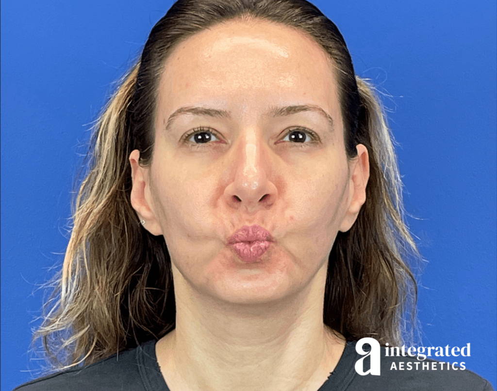 01070-Botox-after-kiss-17
