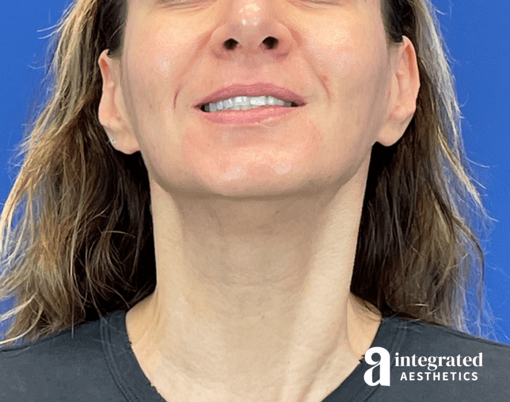 01070-Botox-after-neck-bands-23