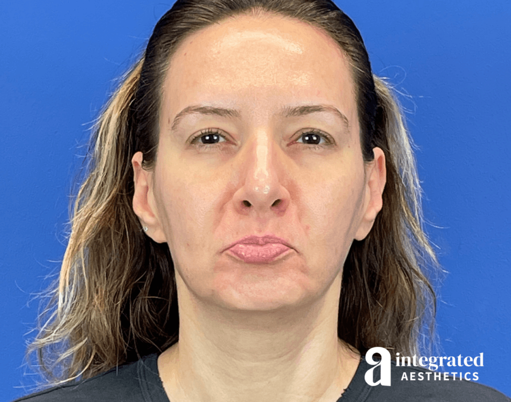 01070-Botox-after-pout-21